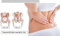 Điều trị viêm vùng chậu