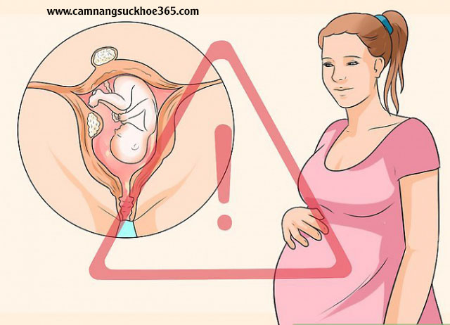 Cảnh báo tình trạng mang thai khi bị u xơ cổ tử cung