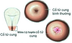 viêm lộ tuyến cổ tử cung