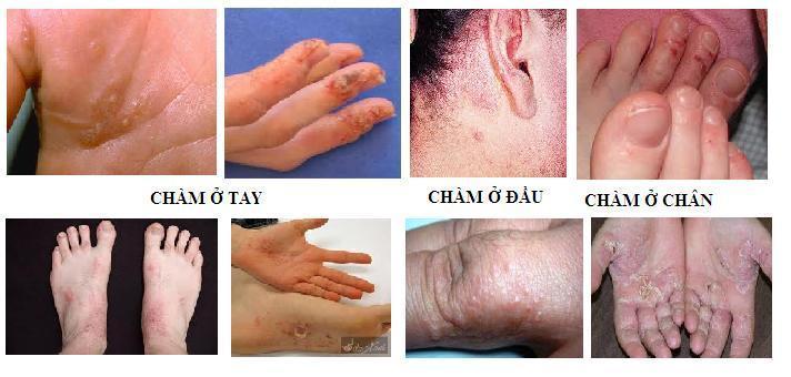 5-can-benh-ngoai-da-thuong-gap-va-cach-dieu-tri. 3