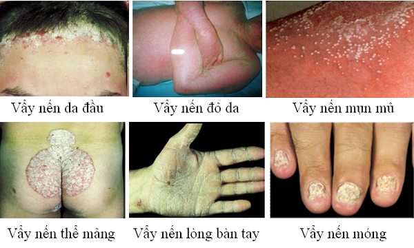 cay-luoc-vang-co-chua-duoc-benh-vay-nen-khong. 1