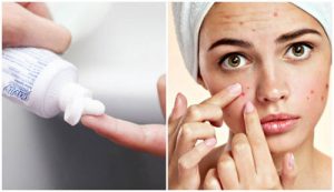 cách trị mụn bằng kem đánh răng