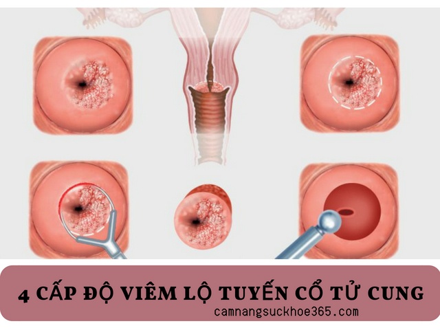 Một số dạng viêm lộ tuyến cổ tử cung thường gặp