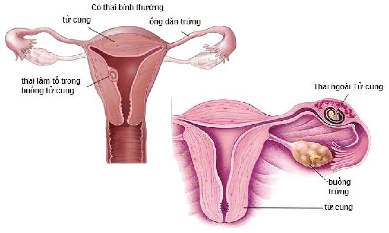 tắc vòi trứng