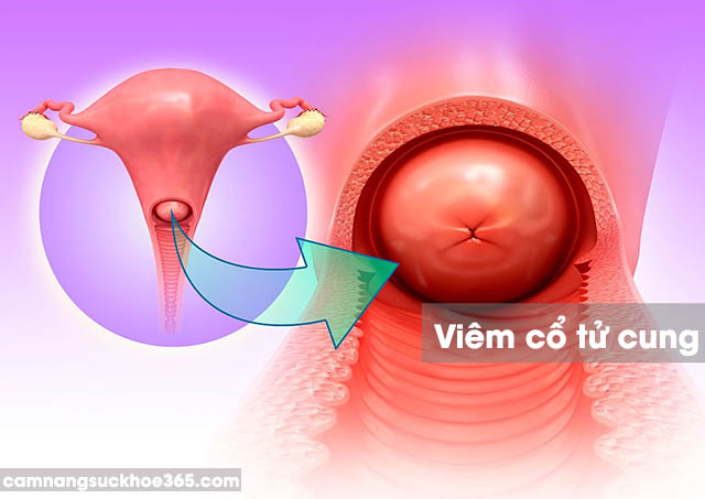 Viêm cổ tử cung