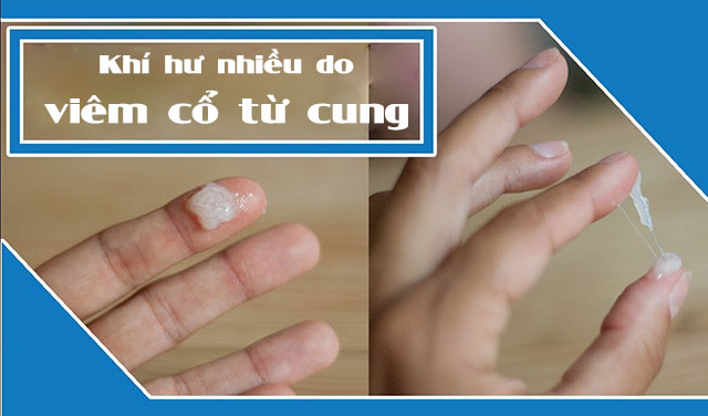 Dấu hiệu viêm cổ tử cung