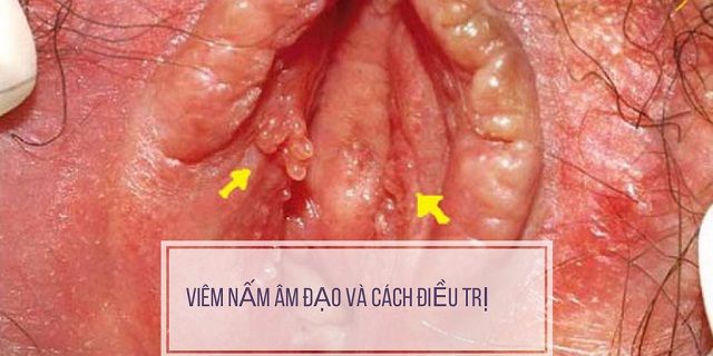 Nguyên nhân nấm âm đạo