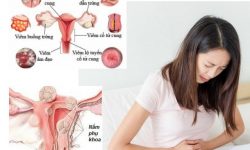 9 cách chữa bệnh nấm phụ khoa