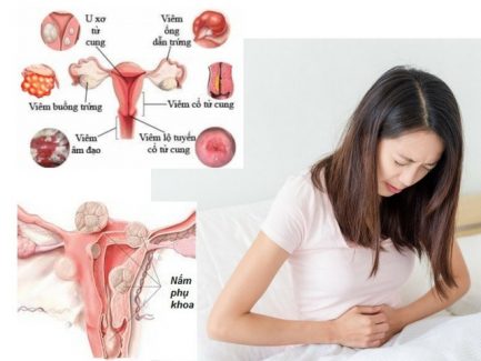9 cách chữa bệnh nấm phụ khoa