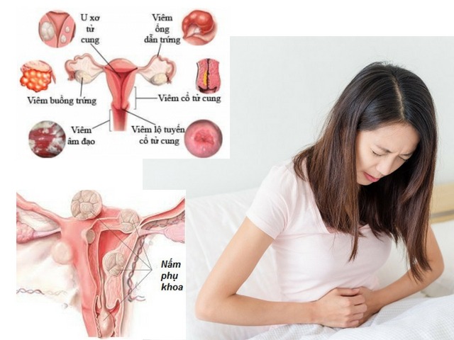 Cách chữa bệnh nấm phụ khoa