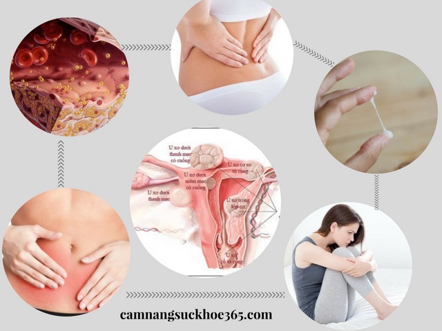 Triệu chứng u xơ cổ tử cung
