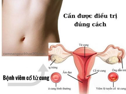 Cách điều trị viêm cổ tử cung