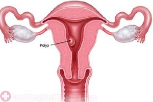 Bệnh Polyp cổ tử cung gây khí hư ra nhiều loãng như nước