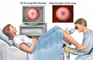 kiêng gì sau khi đốt viêm lộ tuyến