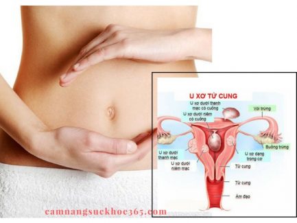 Triệu chứng u xơ cổ tử cung nặng