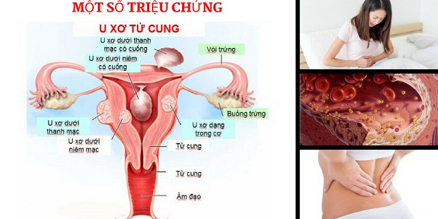 Triệu chứng u xơ cổ tử cung