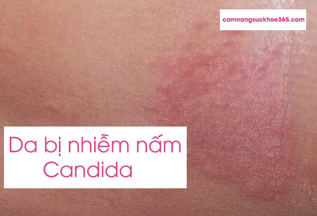Triệu chứng nhiễm nấm candida ở da
