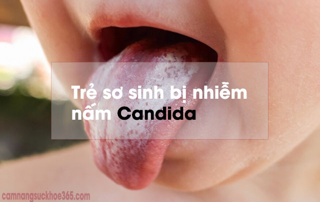 Triệu chứng nhiễm nấm candida ở miệng