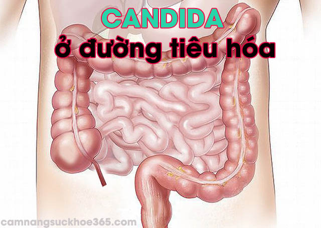 Nhiễm nấm candida ở đường tiêu hóa