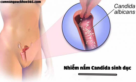 Triệu chứng nấm candida