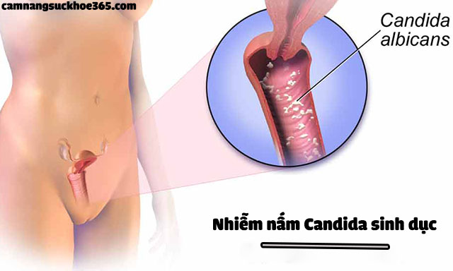 Nấm candida sinh dục