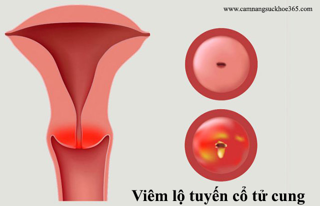 Viêm lộ tuyến cổ tử cung