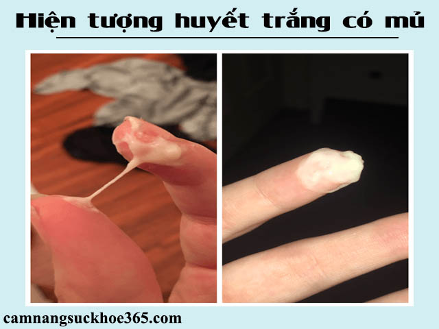 Huyết trắng có mủ
