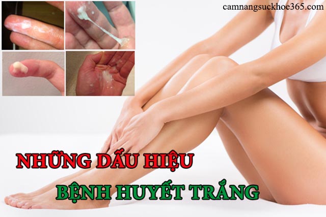 Triệu chứng bệnh huyết trắng có mủ