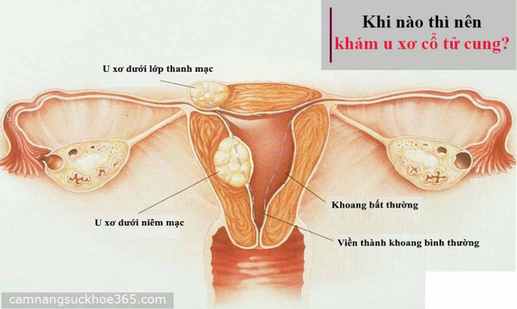 Hình ảnh giải phẫu của bệnh u xơ cổ tử cung