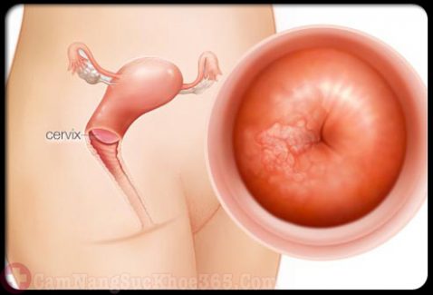 Dấu hiệu viêm cổ tử cung nhẹ