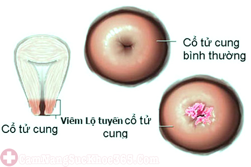 Triệu chứng viêm cổ tử cung 