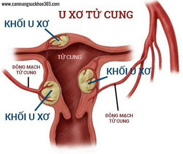Một số biến chứng của bệnh u xơ tử cung