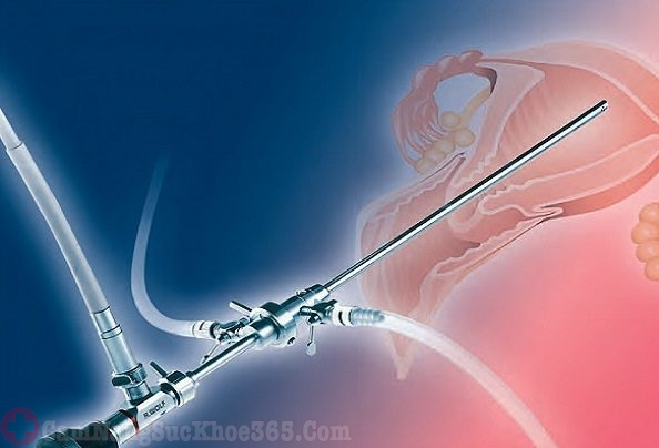 Nội soi cổ tử cung phát hiện viêm lộ tuyến cổ tử cung