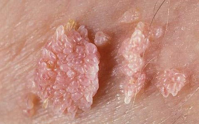 Ngứa âm đạo là dấu hiệu bệnh sùi mào gà