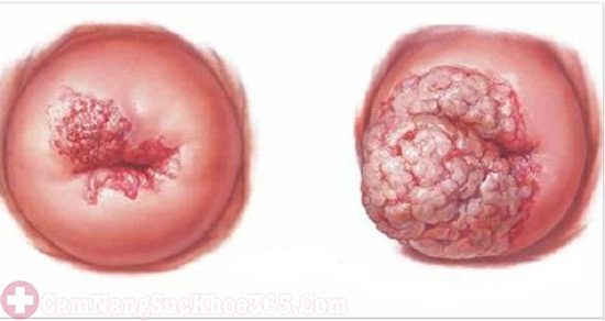 Viêm lộ tuyến cổ tử cung 3cm là tình trạng viêm nhiễm nặng