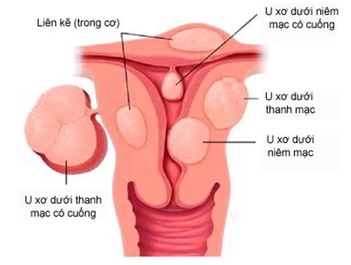 U xơ tử cung dưới thanh mạc 
