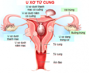 mới mổ u xơ tử cung nên ăn gì?