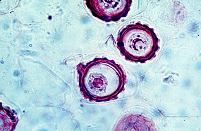 Phác đồ trị viêm âm đạo do nấm candida hiệu quả