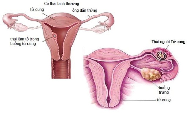 Triệu chứng bệnh viêm vùng chậu