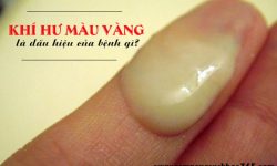 Khí hư màu vàng là dấu hiệu của bệnh gì?