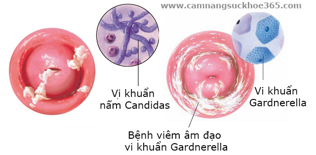Bệnh viêm âm đạo vi khuẩn Gardnerella