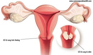Bệnh viêm cổ tử cung nguy hiểm như thế nào?