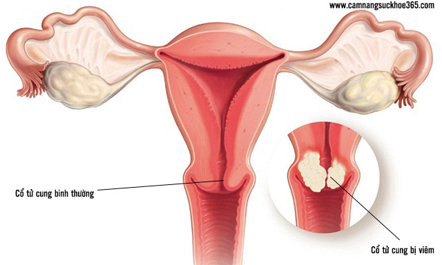 Bệnh viêm cổ tử cung nguy hiểm như thế nào?