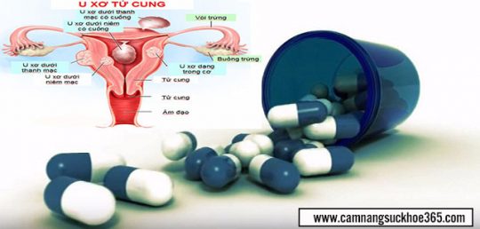 Bị u xơ tử cung nên uống thuốc gì cho nhanh khỏi?