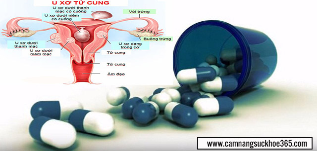 Bị u xơ tử cung nên uống thuốc gì cho nhanh khỏi?