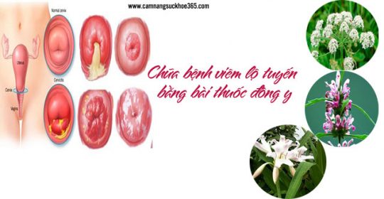 Chữa bệnh viêm lộ tuyến bằng bài thuốc đông y