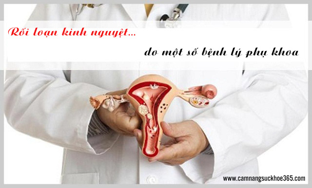 Nguyên nhân gây rối loạn kinh nguyệt