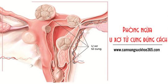 Hướng dẫn phòng ngừa u xơ tử cung đúng cách