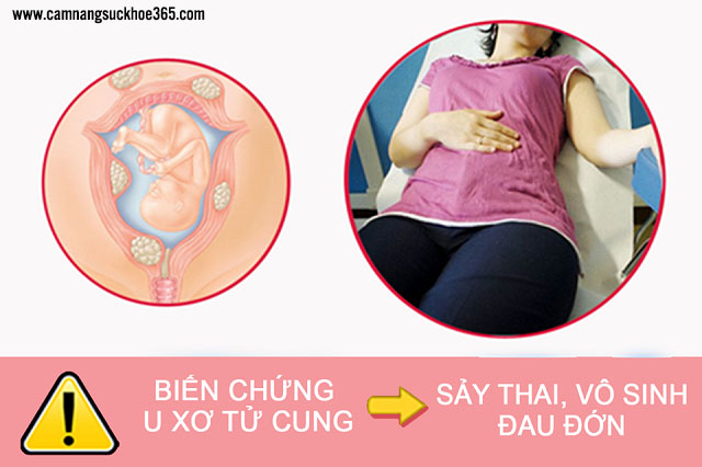 Biến chứng của bệnh u xơ tử cung