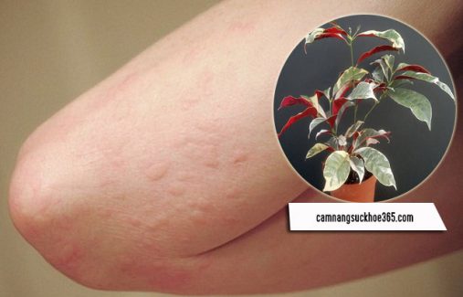 chữa bệnh mề đay bằng lá đơn đỏ